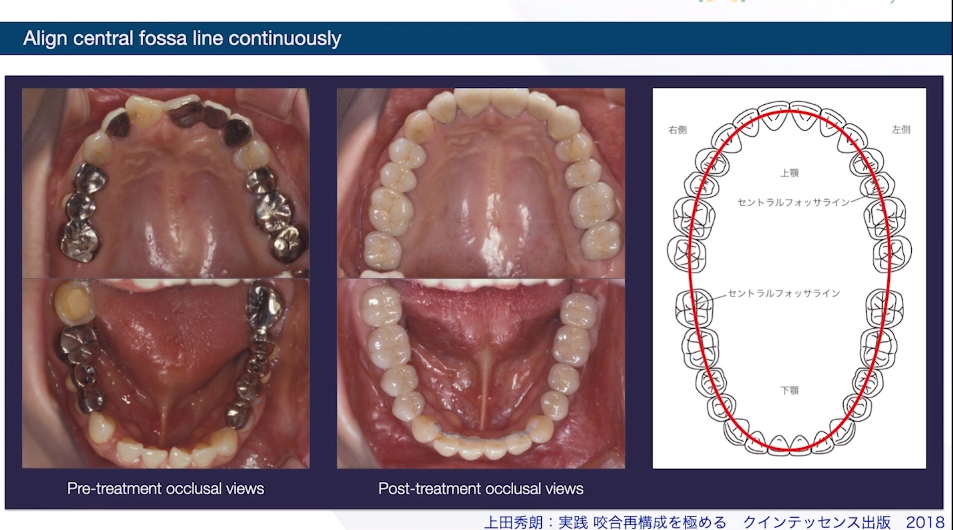 実践 咬合再構成を極める 歯列不正、歯周疾患、多数歯欠損を読み解く - 本