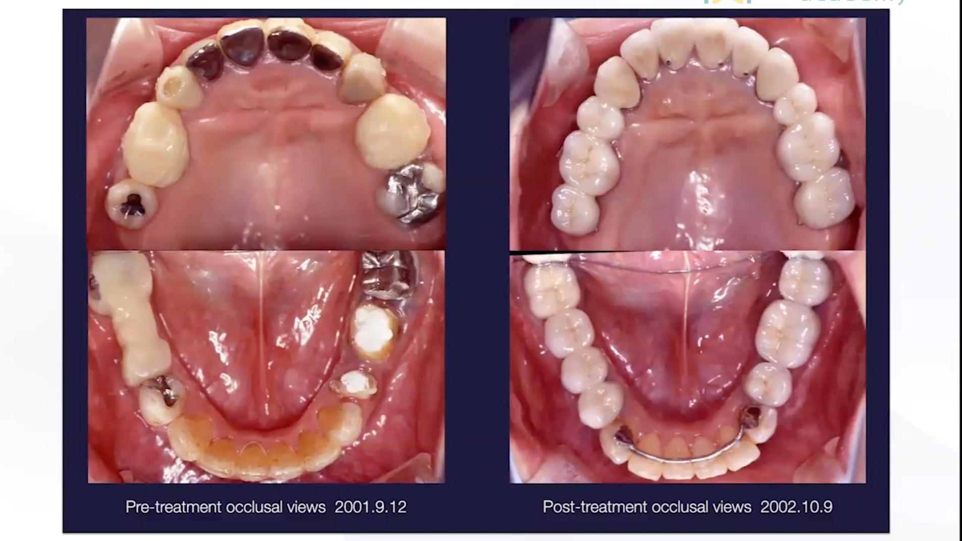 実践 咬合再構成を極める 歯列不正、歯周疾患、多数歯欠損を読み解く - 本