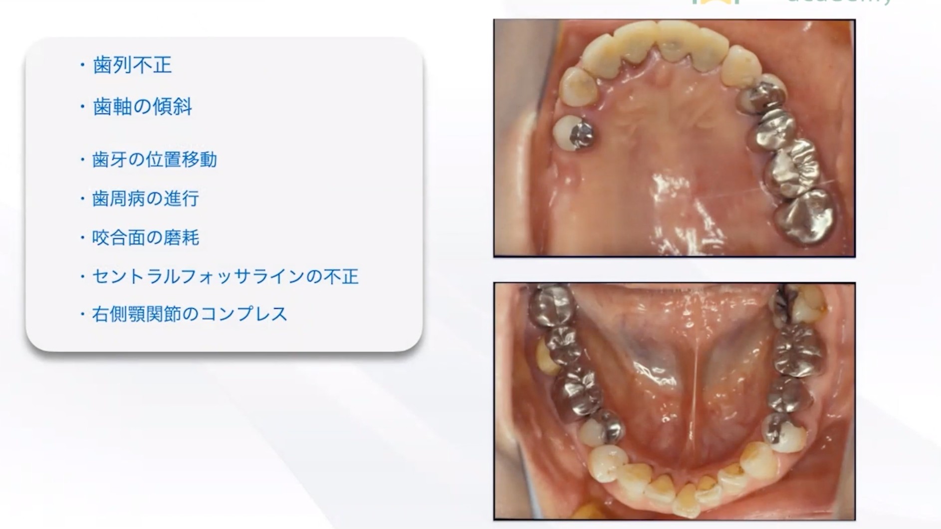 人気動画】長期安定のための咬合構成を極める〜総合的な治療介入方法と