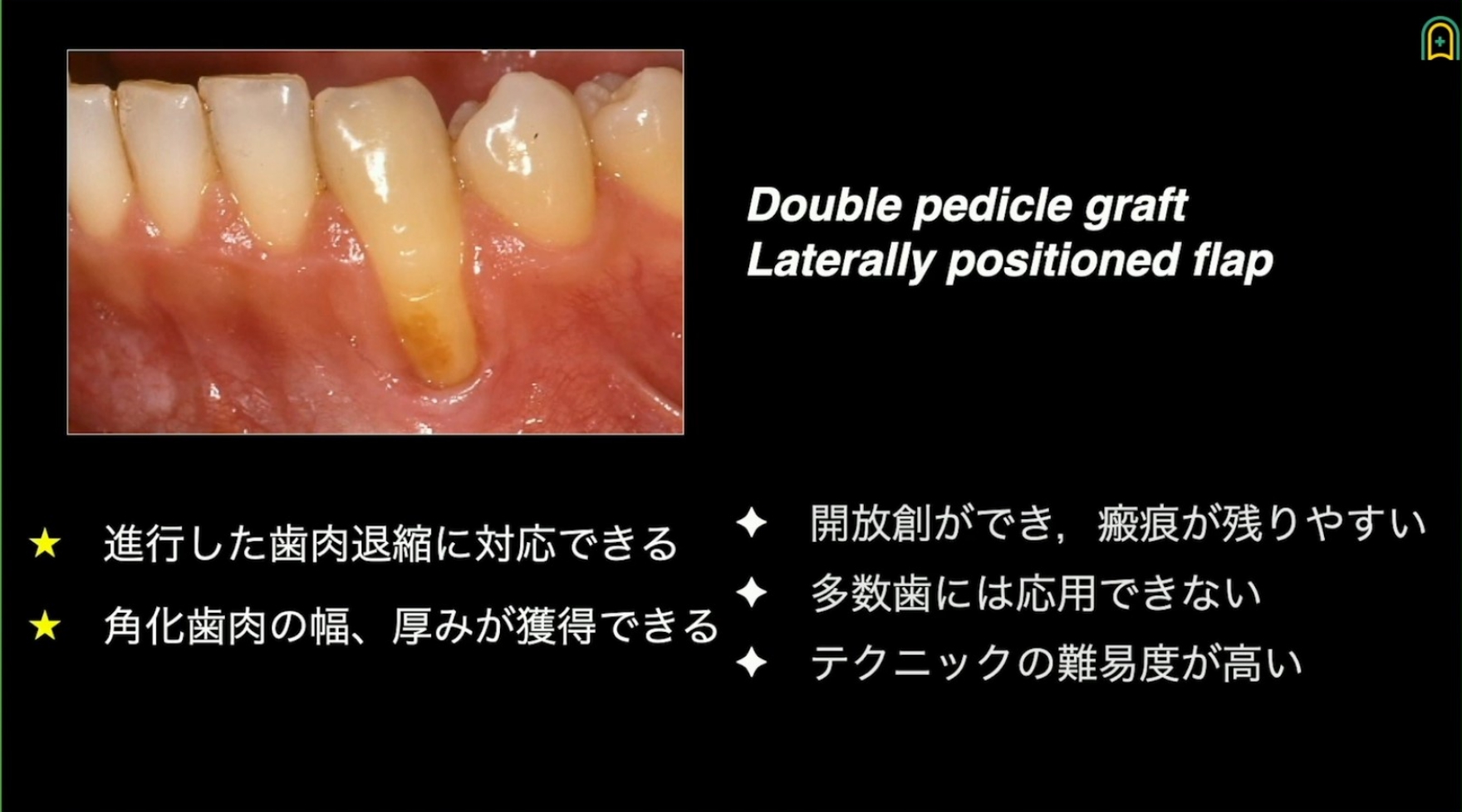 人気動画】安全安心確実な根面被覆術/松井徳雄先生 | Doctorbook 