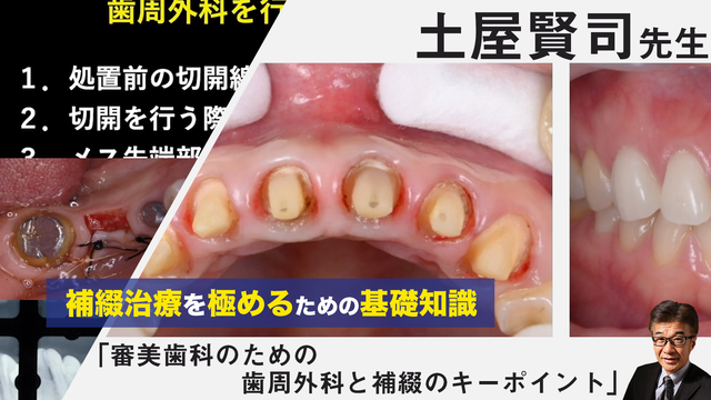 補綴治療を極めるための基礎知識「審美歯科のための歯周外科と補綴の 