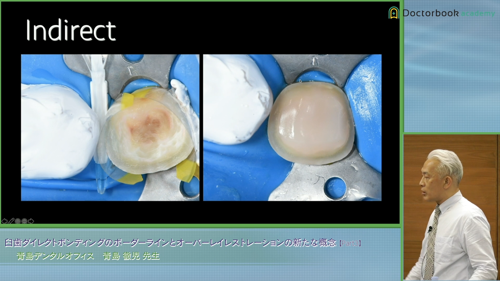 象牙質部の処理