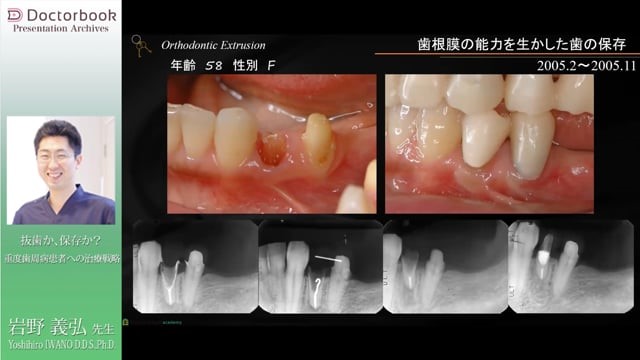 『抜歯か、保存か？ 重度歯周病患者への治療戦略』動画サムネイル