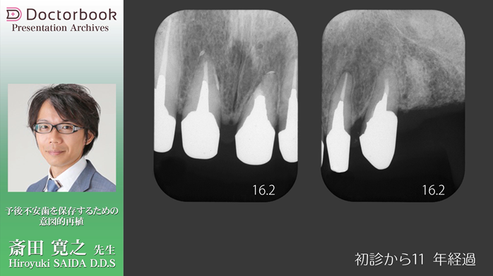 『予後不安歯を保存するための意図的再植』動画サムネイル