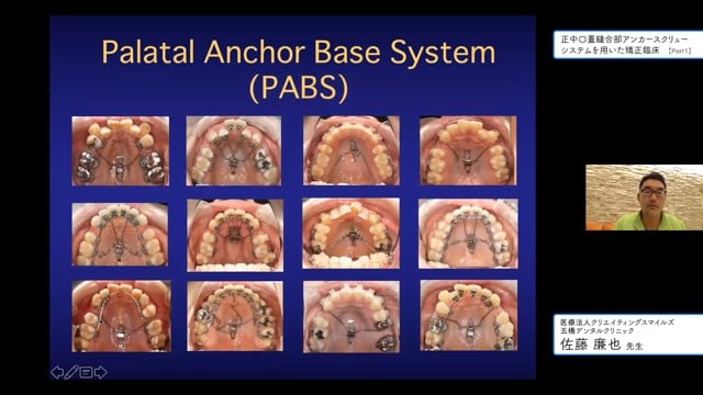 『正中口蓋縫合部アンカースクリューシステムを用いた矯正臨床』動画サムネイル