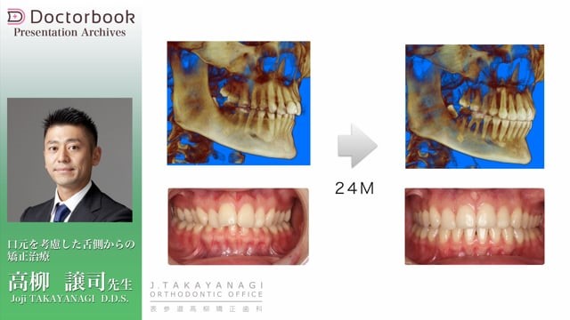 『口元を考慮した舌側からの矯正治療』動画サムネイル