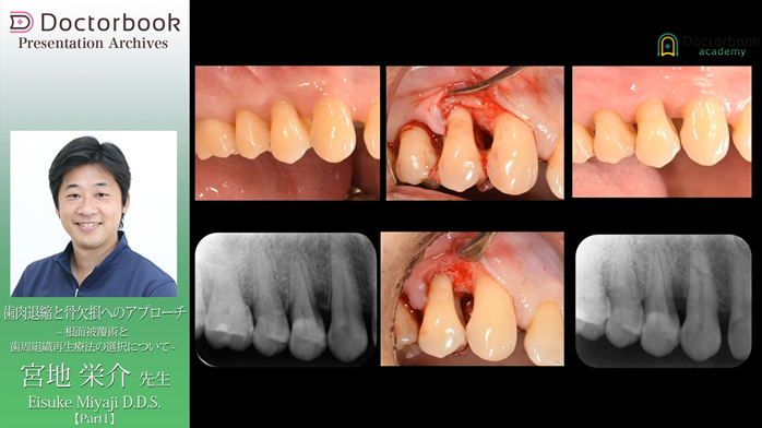 「歯肉退縮と骨欠損へのアプローチ　～混綿被覆術と歯周組織再生療法の選択について～」動画サムネイル