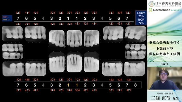 「重篤な骨吸収を伴う下顎前歯の保存に努めた１症例」動画サムネイル