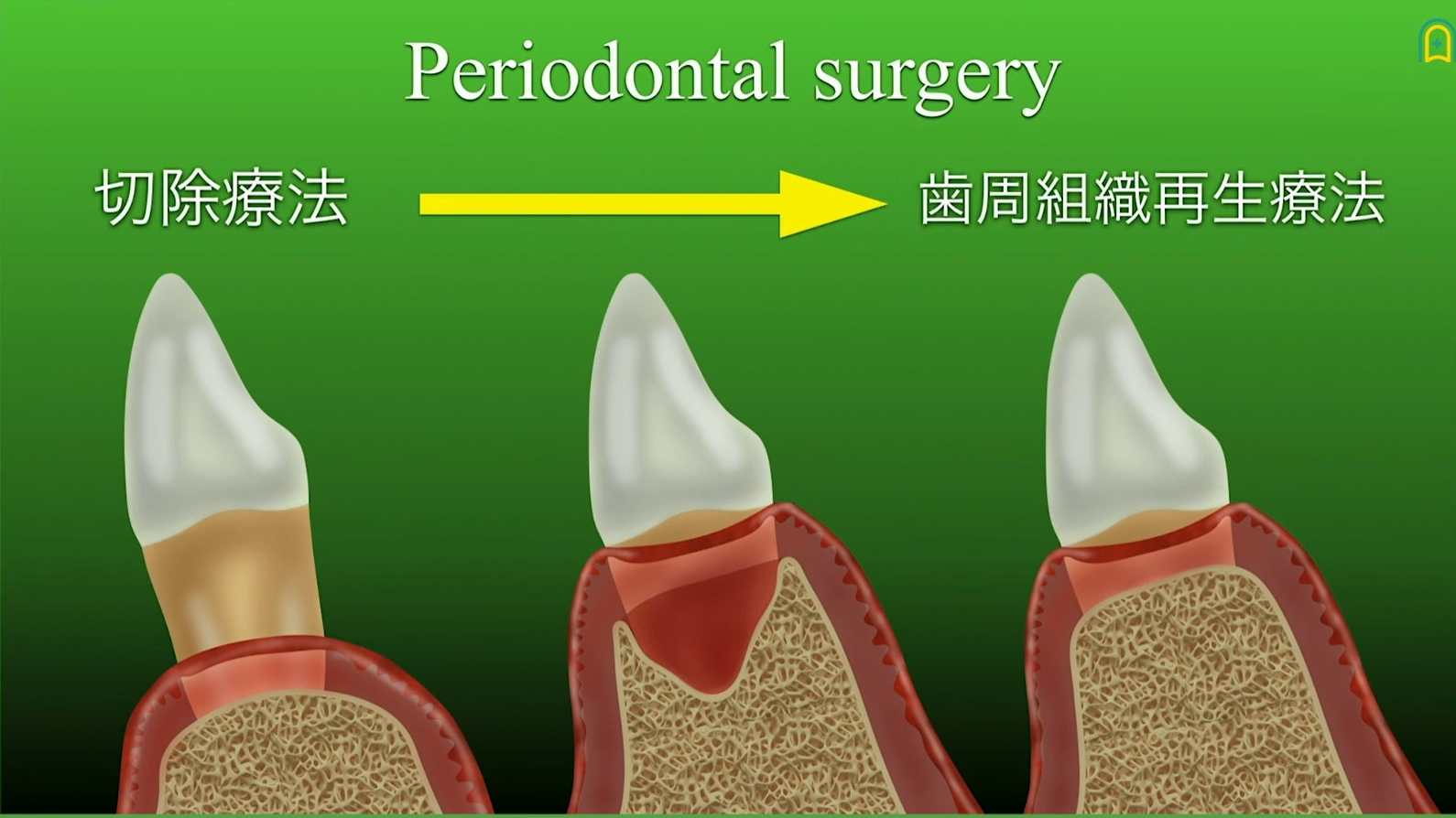人気動画】歯周組織再生療法～マイクロサージェリーによる進化～(垂直性骨欠損編） | Doctorbook academy (ドクターブックアカデミー)