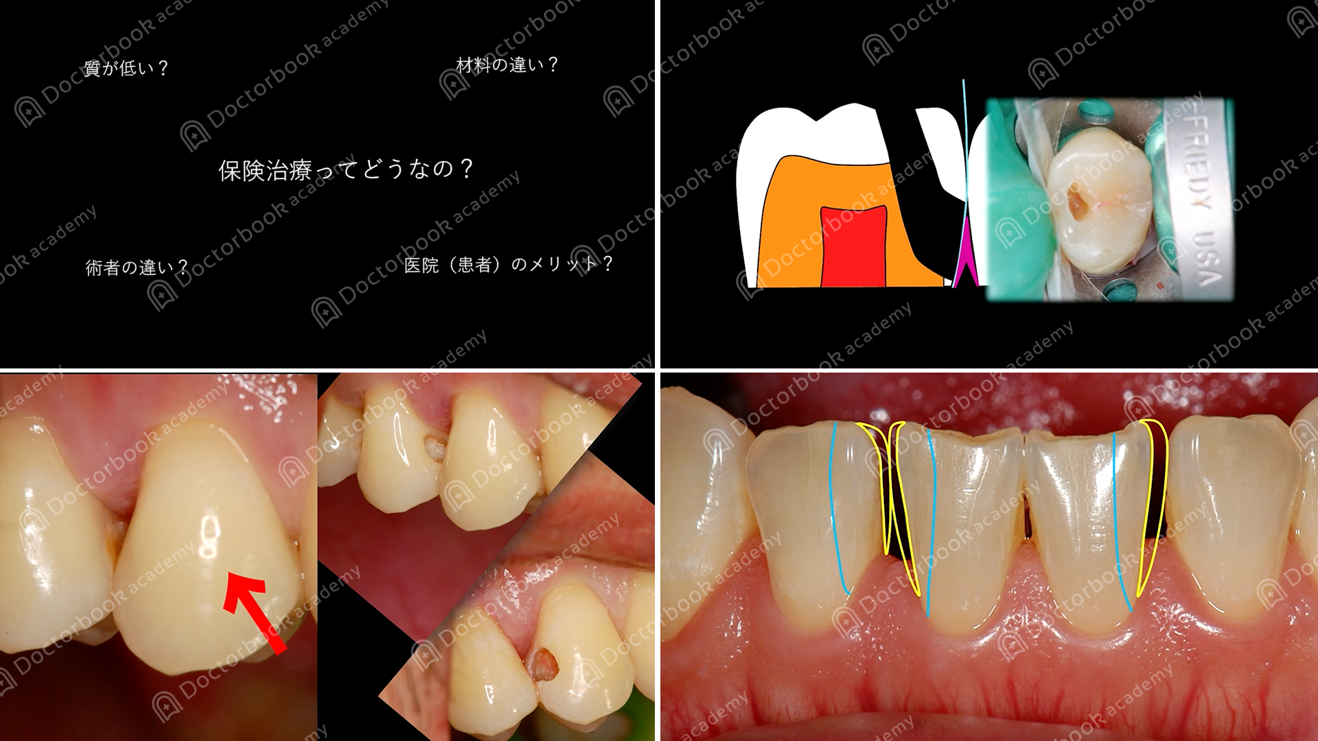 The Direct Bonded Restoration 〜保険治療の限界と自費治療の考え方編〜 #2 八木洋二郎先生