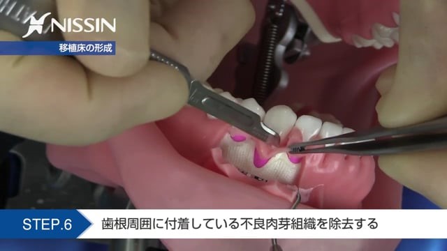 歯周外科の基礎【動画でスキルアップ】 | Doctorbook academy 