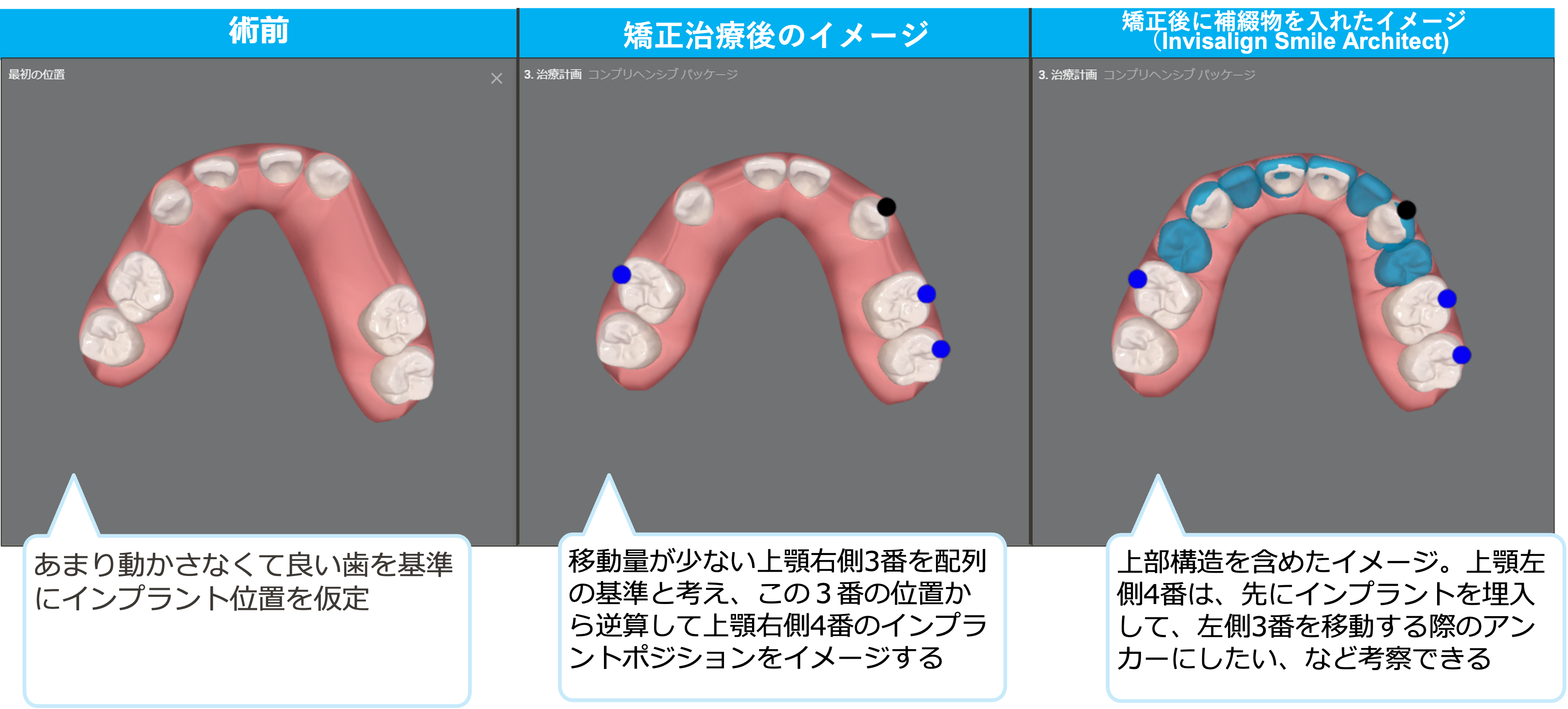 矯正と補綴の治療計画をシームレスに。 | Doctorbook academy 