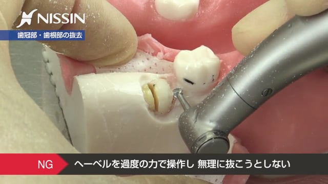 埋伏抜歯の基礎【動画でスキルアップ】 | Doctorbook academy 