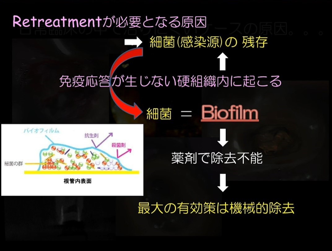 Evidence & TechniqueNiTiロータリーファイルを効果的に使う実践歯内療法 [単行本（ソフトカバー）] 阿部 修