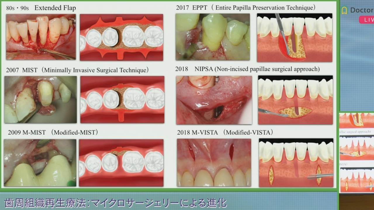 開催報告】「️歯周組織再生療法：マイクロサージェリーによる進化（垂直性骨欠損編）」山口 文誉 先生クリニカル・カンファレンス | Doctorbook  academy (ドクターブックアカデミー)