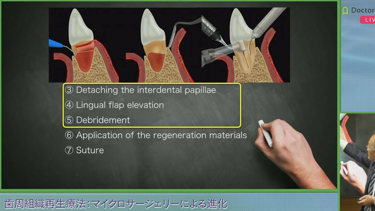 開催報告】「️歯周組織再生療法：マイクロサージェリーによる進化（垂直性骨欠損編）」山口 文誉 先生クリニカル・カンファレンス | Doctorbook  academy (ドクターブックアカデミー)