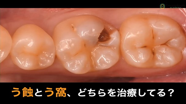 人気動画】う蝕う窩治療の成功の分かれ道〜新時代のカリオロジー