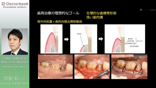 生理的な歯槽骨形態獲得のための歯周外科 