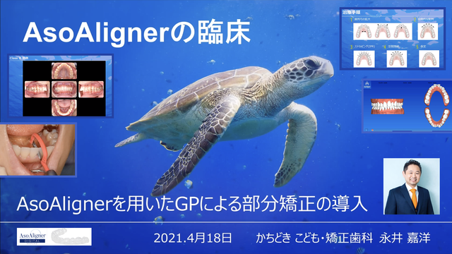 「ASOAlignerサティフィケートセミナー」【有料公開】AsoAlignerの臨床 - AsoAlignerを用いたGPによる部分矯正の導入 -