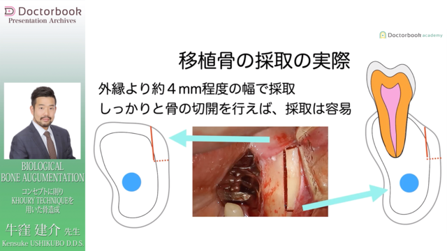 BIOLOGICAL BONE AUGUMENTATION コンセプトに則りKHOURY TECHNIQUEを用いた骨造成