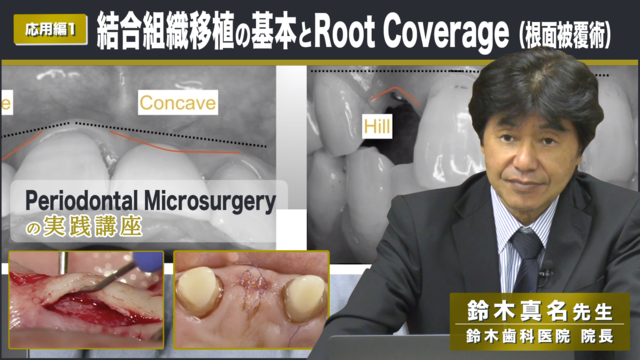 応用編１「結合組織移植の基本とRoot Coverage（根面被覆術 ...