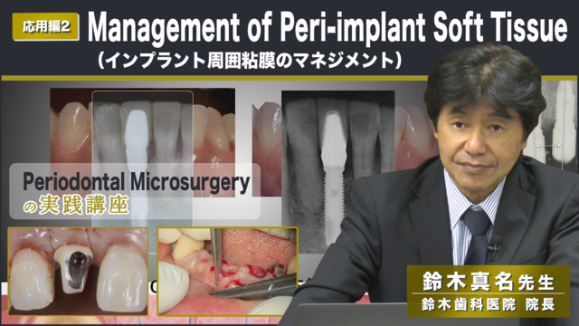 応用編2「Management of Peri-implant Soft Tissue（インプラント周囲粘膜のマネジメント）」