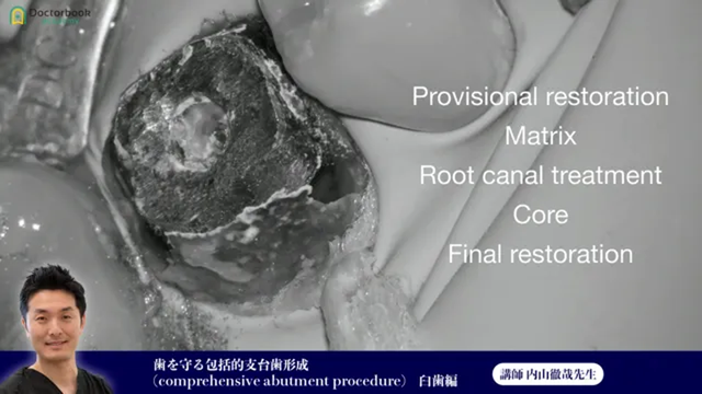 ⑲歯を守る包括的支台歯形成(comprehensive abutment procedure) 臼歯編