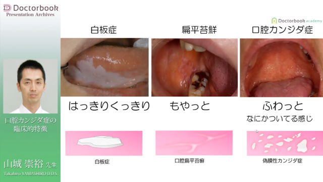 口腔カンジダ症の臨床的特徴