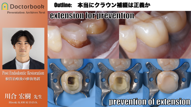 Post Endodontic Restoration 根管治療後の修復処置