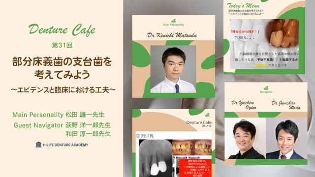 部分床義歯の支台歯を考えてみよう 〜エビデンスと臨床における工夫〜│Denture cafe 第31回