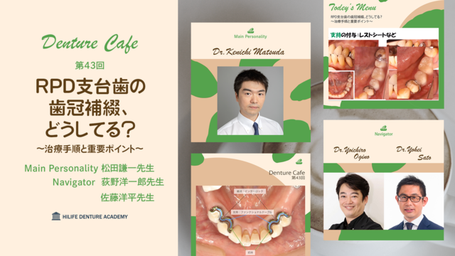 RPD支台歯の歯冠補綴、どうしてる？〜治療手順と重要ポイント〜│Denture Cafe 第43回