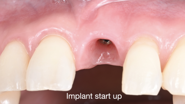 【満席キャンセル待ち】【GSC hands-on course】Implant start up インプラント〜スタートアップ〜 - 2days