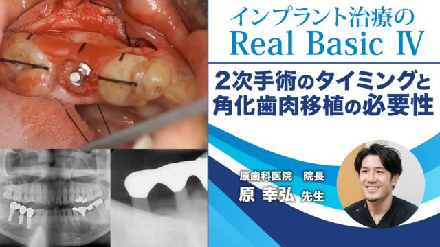 2次手術のタイミング・角化齒肉移植の必要性│インプラント治療のReal Basic Ⅳ