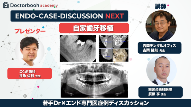 Book Rev.】再根管治療の成功率を高めるスカンジナビアエンド 