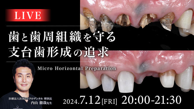 Micro Horizontal Preparation 〜歯と歯周組織を守る支台歯形成の追求〜