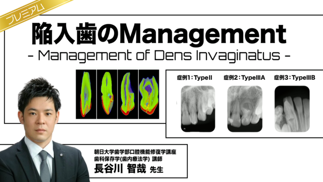 陥入歯のManagement -Management of Dens Invaginatus -