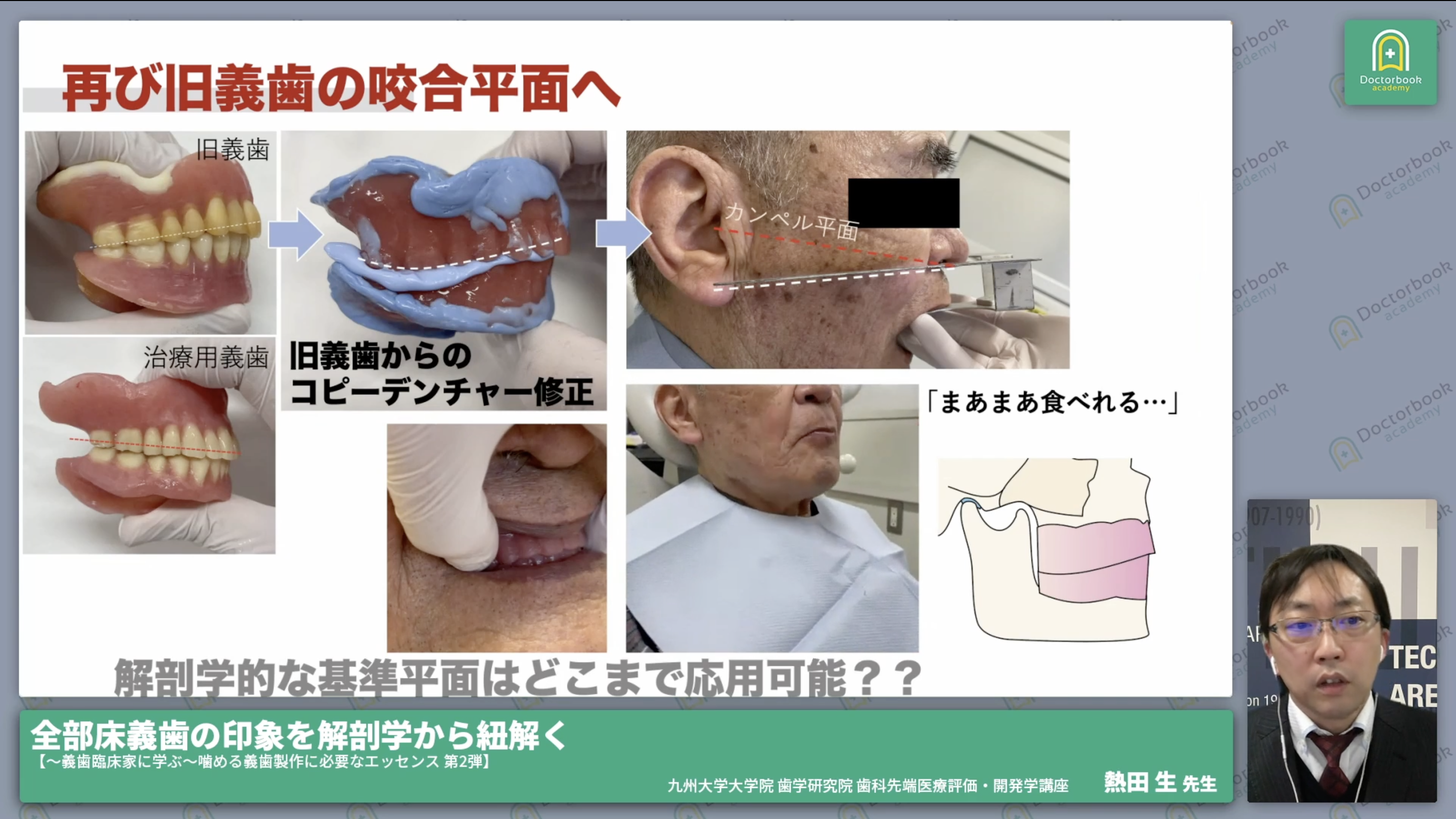 全部床義歯の印象を解剖学から紐解く【〜義歯臨床家に学ぶ〜噛める義歯製作に必要なエッセンス 第2弾】