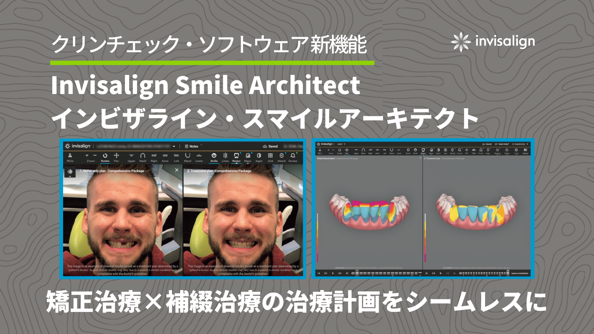 クリンチェック・ソフトウェア内の新機能のご紹介  『Invisalign Smile Architect（インビザライン・スマイルアーキテクト』  ～矯正治療×補綴治療を一つの治療計画で～