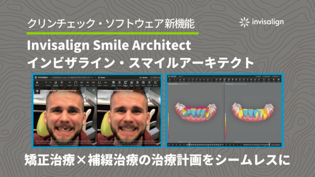 クリンチェック・ソフトウェア内の新機能のご紹介 『Invisalign Smile Architect（インビザライン・スマイルアーキテクト』 ～矯正治療×補綴治療を一つの治療計画で～