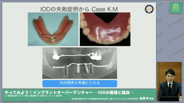 やってみよう！インプラントオーバーデンチャー ―IODの基礎と臨床―【〜義歯臨床家に学ぶ〜噛める義歯製作に必要なエッセンス 第4弾】