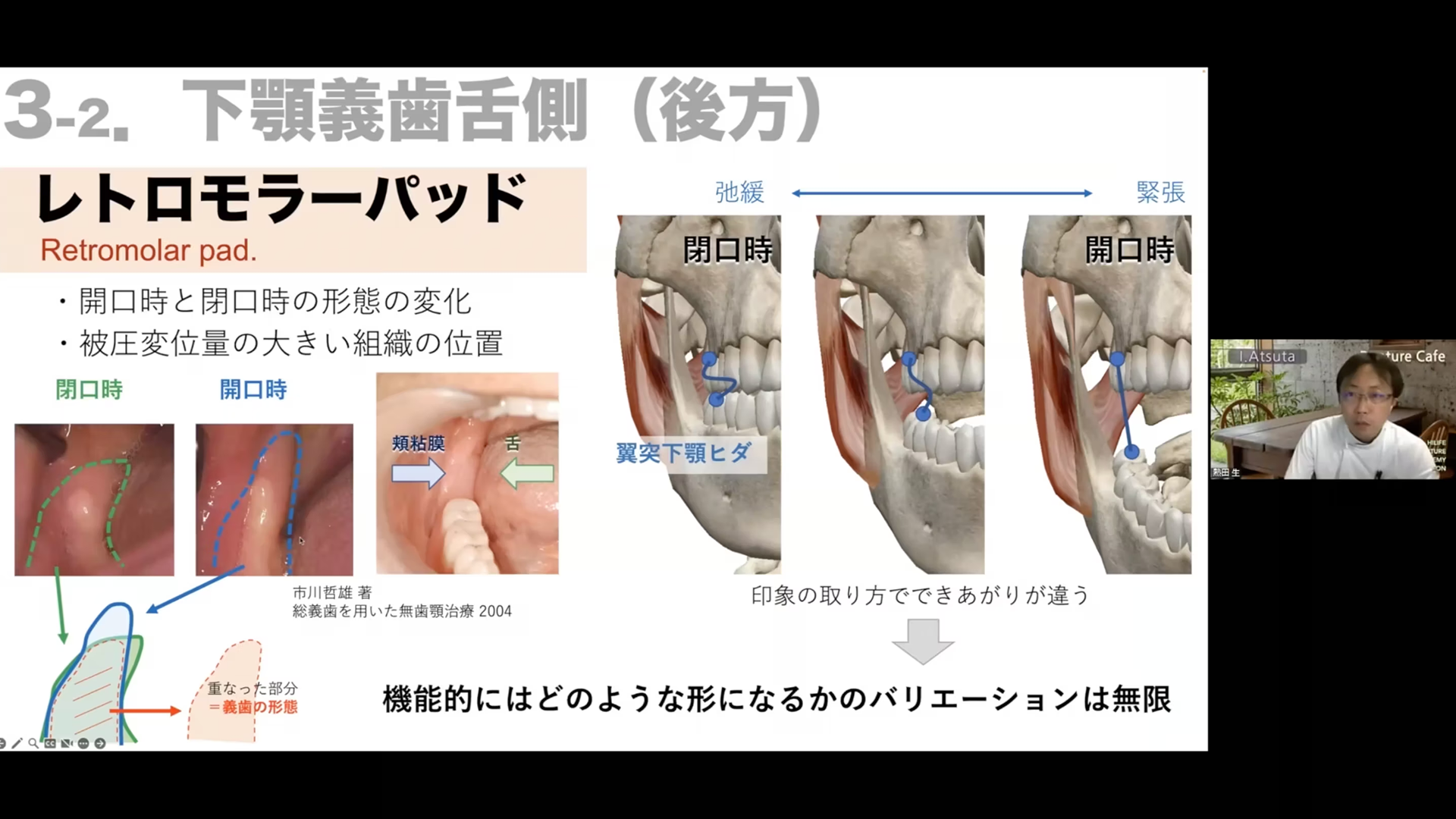 義歯辺縁を形作る舌側解剖│熱田生先生│Denture Cafe 第41回 #1