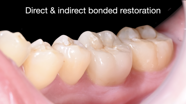 【満席キャンセル待ち】【GSC hands-on course】Direct & indirect bonded restorations basic hands-on CR・インレー・アンレー - 4days