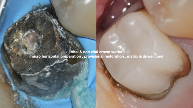 【満席キャンセル待ち】【GSC hands-on course】Vital & non vital crown works (micro horizontal preparation, provisional restoration , matrix & dowel core) basic hands-on MI歯冠補綴 〜形成・プロビジョナルレストレーション〜 - 4days