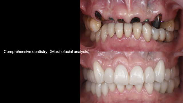 【満席キャンセル待ち】【GSC hands-on course】包括治療コース 〜Maxillofacial Analysis〜 - 4days