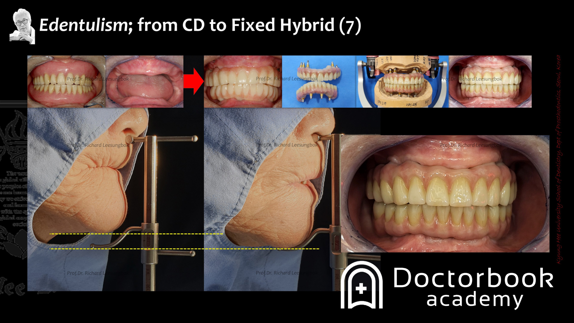 Clinical Approach using the Top-Down Concept: IFHP (Implant-Fixed Hybrid Prosthetic) and CAIS (Computer-Aided Implant Surgery), Treatment Guidelines（Part 2）