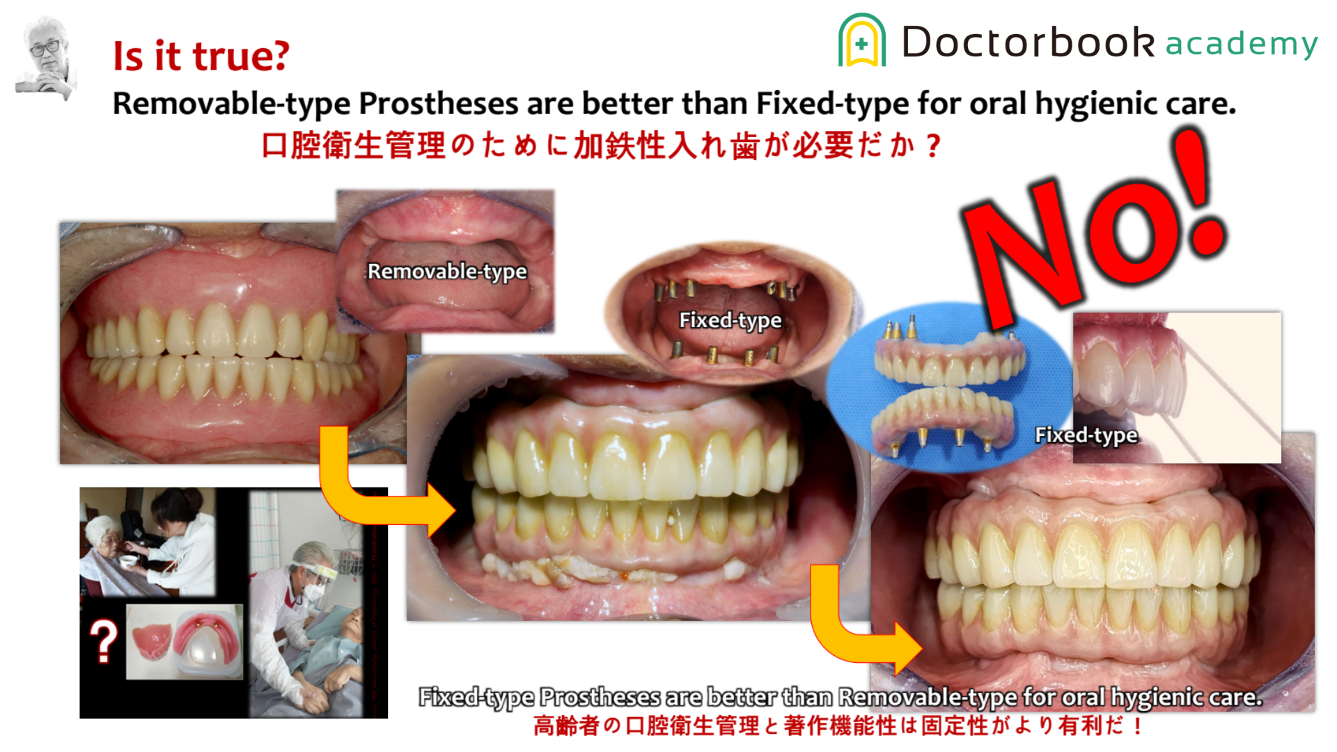 Elderly edentulous transition from Complete Dentures to Fixed hybrid prosthesis, Mutually Protected Occlusion for Fixed Prostheses and Considerations（Part 3）