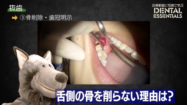 STEP3：骨削除・歯根明示│Dental Essentials vol.4 抜歯