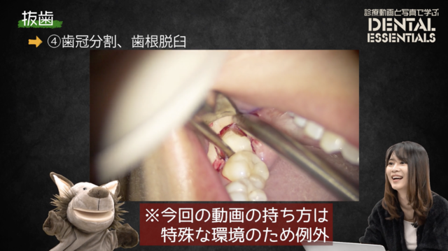 STEP4：歯冠分割・歯根脱臼│Dental Essentials vol.4 抜歯