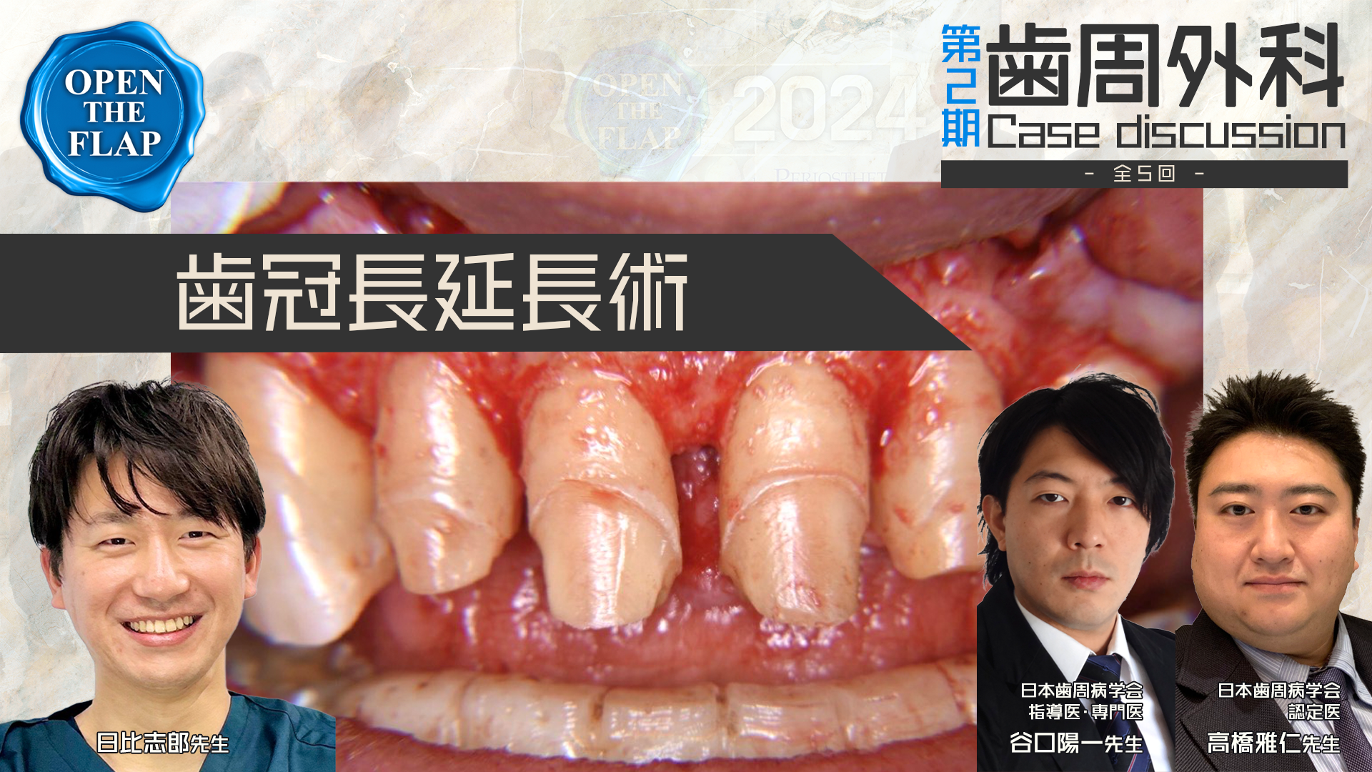 #4 Tooth Wearを認める上顎前歯部に対してクラウンレングスニングを行い審美性を回復した一症例