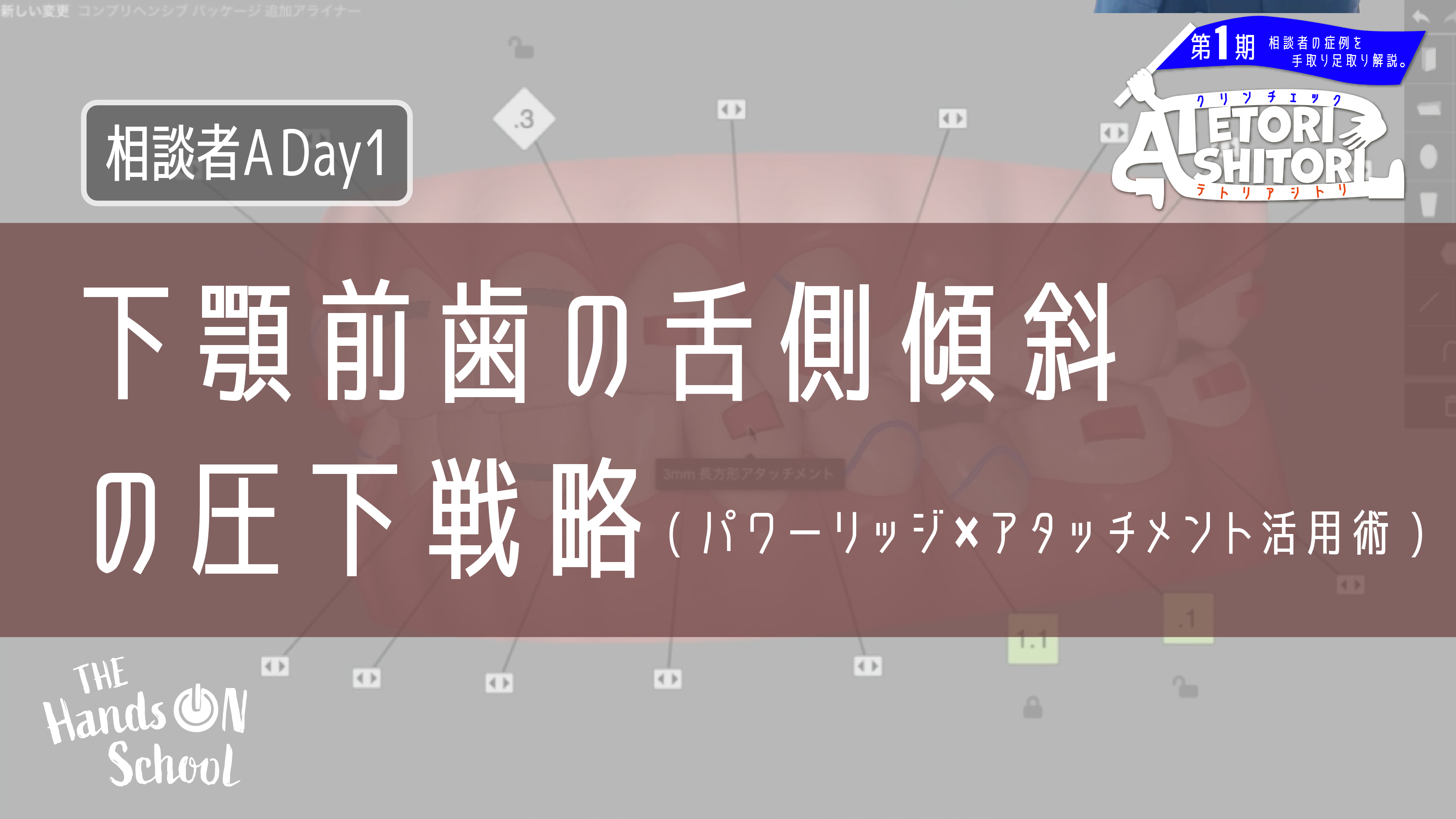 下顎前歯の舌側傾斜の圧下戦略(パワーリッジ×アタッチメント活用術)|相談者A DAY1